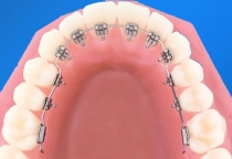 NIỀNG RĂNG MẶT TRONG