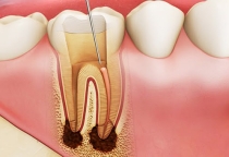 ĐIỀU TRỊ TỦY RĂNG