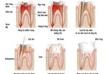 Điều trị tận gốc tủy răng
