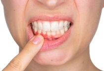 ĐIỀU TRỊ TỤT LỢI CHÂN RĂNG