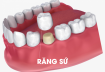 Năm mới 2025 : Lựa chọn phương pháp thay răng sứ để chuẩn bị đón Tết
