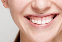 ĐIỀU TRỊ CƯỜI HỞ LỢI
