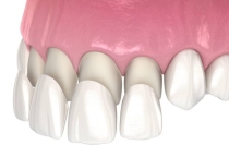 DÁN SỨ VENEER