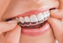 NIỀNG RĂNG INVISALIGN