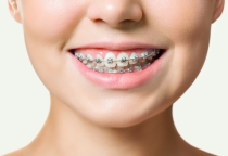 NIỀNG RĂNG MẮC CÀI