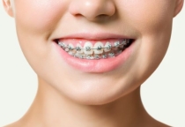 Niềng răng là gì ? Độ tuổi lý tưởng để niềng răng