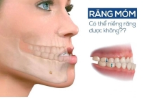 NIỀNG RĂNG MÓM