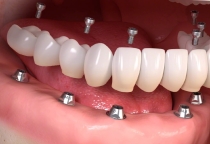 TRỒNG RĂNG IMPLANT TOÀN PHẦN