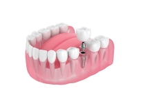 TRỒNG RĂNG IMPLANT
