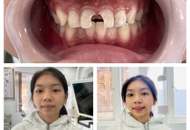Trám răng thẩm mỹ 