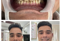 răng sứ đón tết
