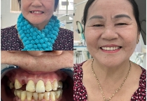 răng sứ