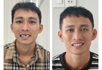  Làm đẹp cho hàm răng : tham khảo trồng răng toàn sứ
