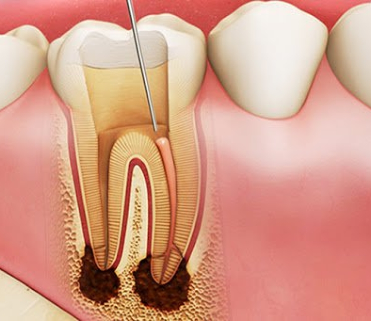 ĐIỀU TRỊ TỦY RĂNG