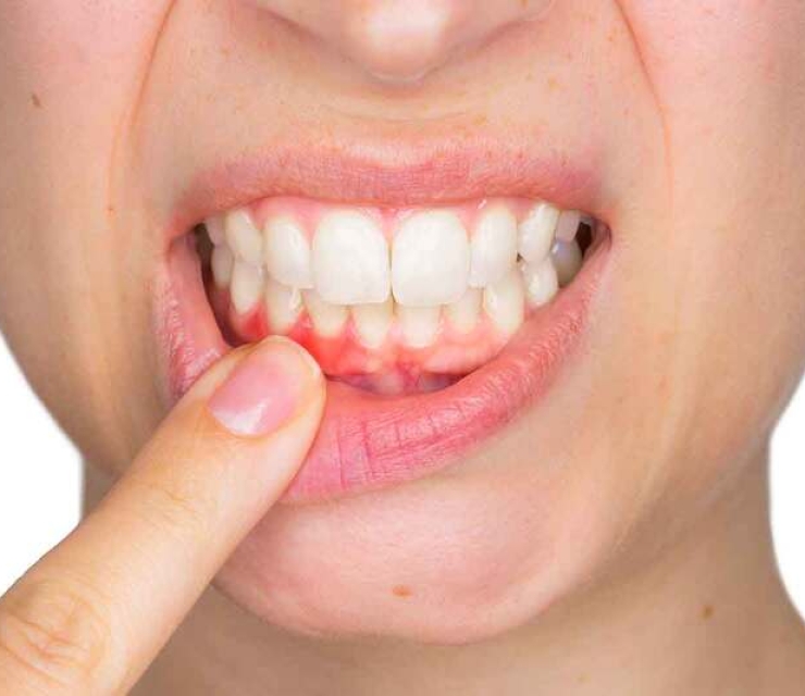 ĐIỀU TRỊ TỤT LỢI CHÂN RĂNG
