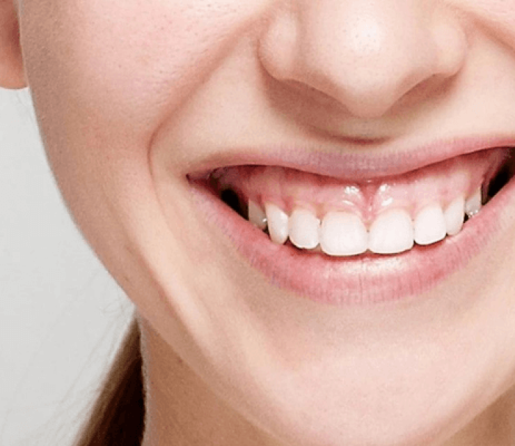 ĐIỀU TRỊ CƯỜI HỞ LỢI
