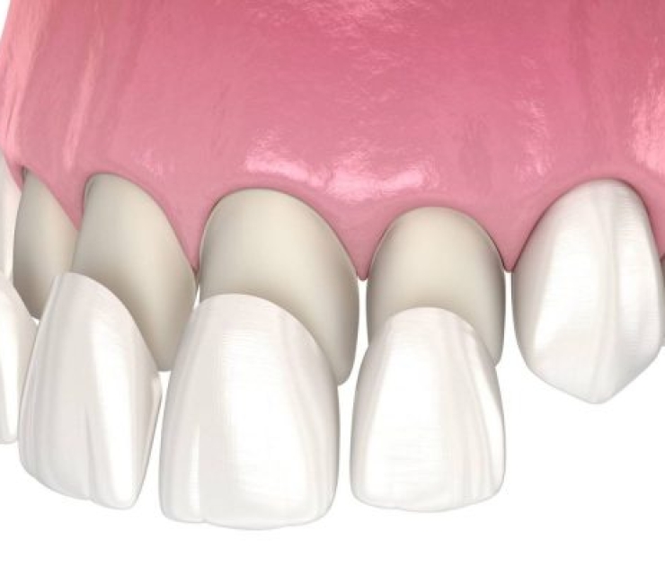 DÁN SỨ VENEER