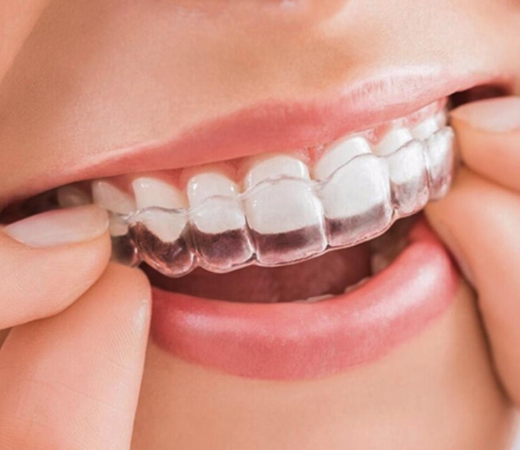 NIỀNG RĂNG INVISALIGN