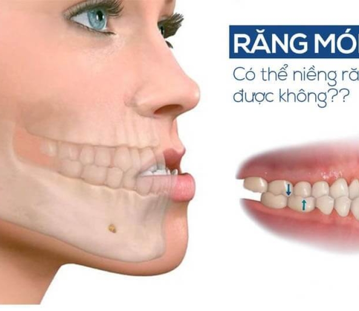 NIỀNG RĂNG MÓM