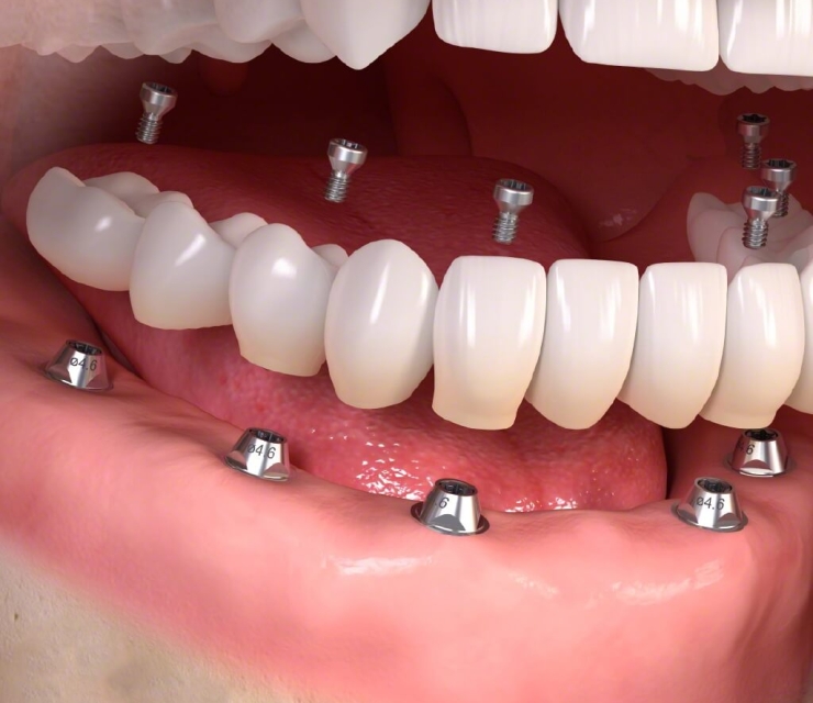 TRỒNG RĂNG IMPLANT TOÀN PHẦN
