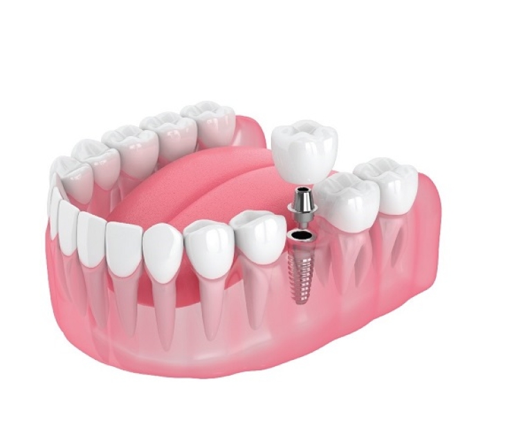 TRỒNG RĂNG IMPLANT