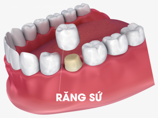 Bọc răng sứ