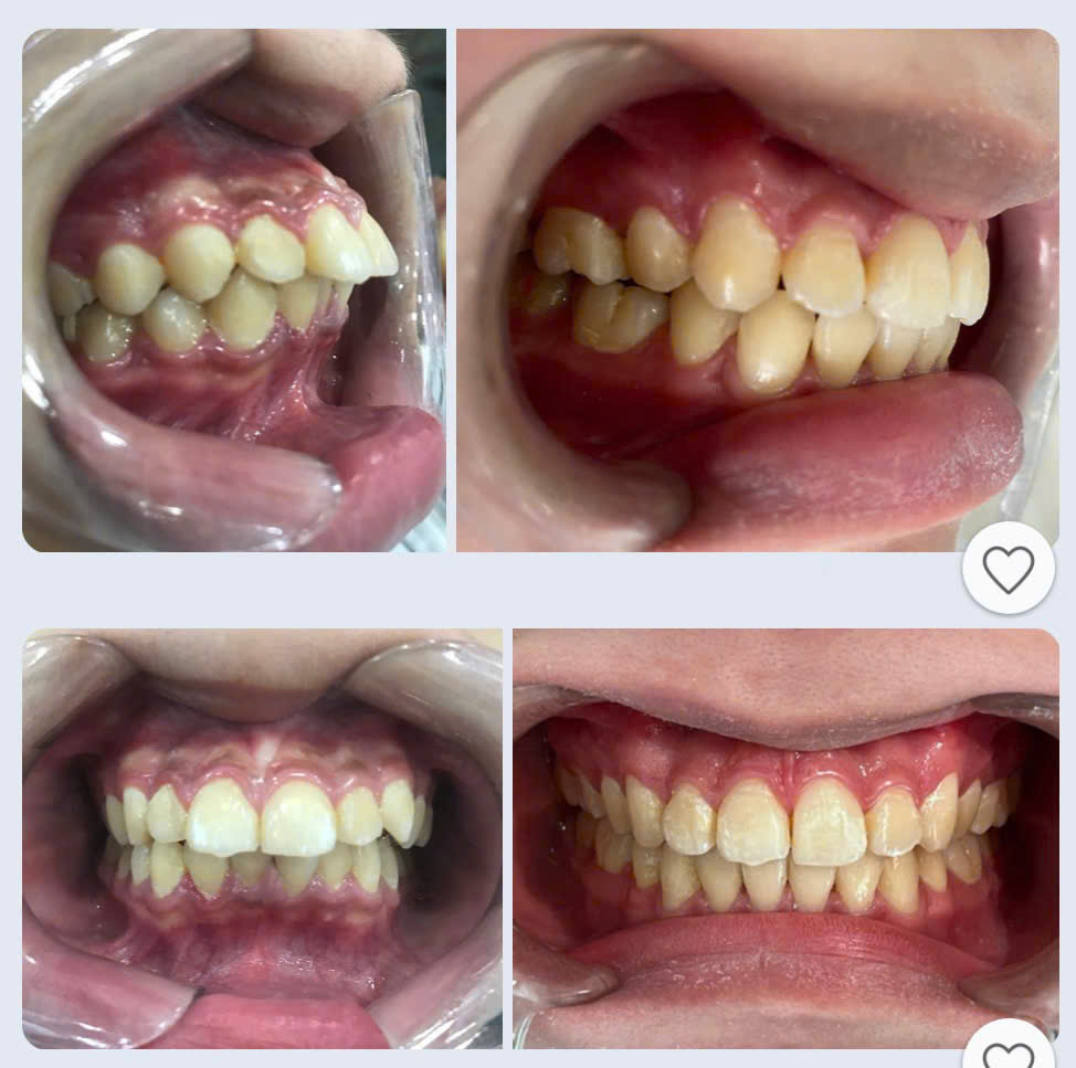 Niềng răng người lớn