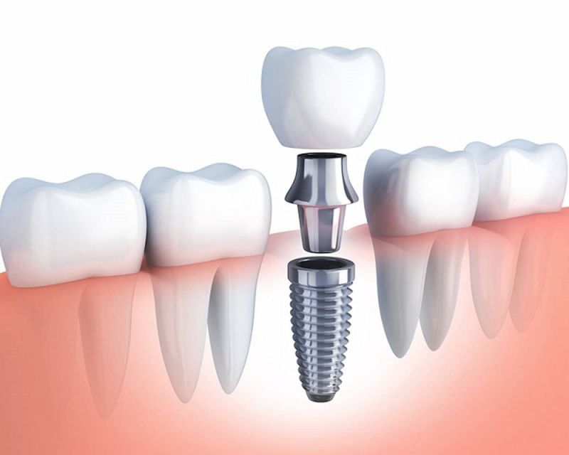 Phục hình răng sứ implant